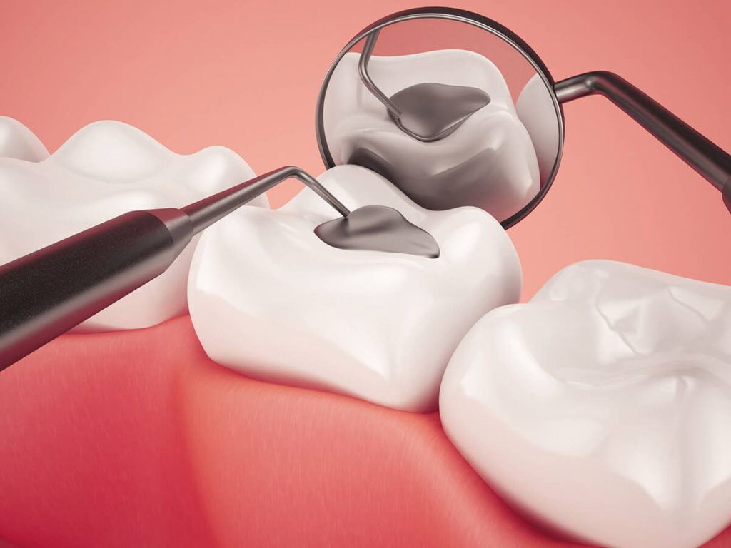 The Waiting Game: How Fast Can a Cavity Form?